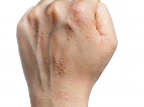 La dermatite atopica negli adulti
