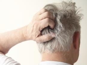 Dermatite ai capelli