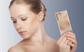 Dermatite del viso