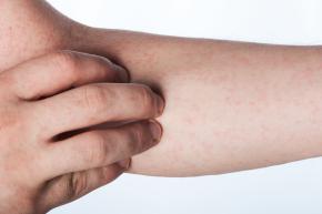 Orticaria da sforzo
