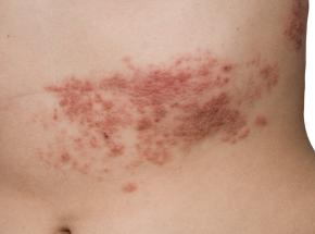 Dermatite erpetiforme 