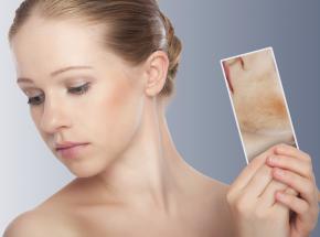 Dermatite del viso