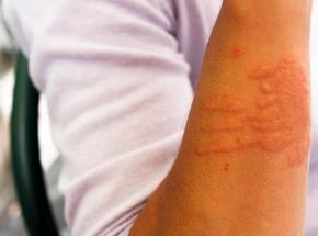 Eczema asteatosico