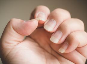 Micosi unghie rimedi naturali