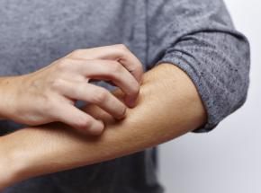 Psoriasi eruttiva