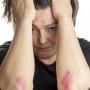 Dermatite da stress 