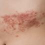 Dermatite erpetiforme