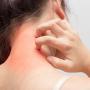 Dermatosi infiammatoria
