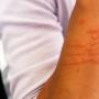 Eczema asteatosico