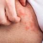 Eczema impetiginizzato