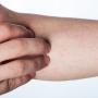 Orticaria da sforzo