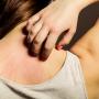 Orticaria da stress