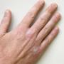 Psoriasi alle unghie